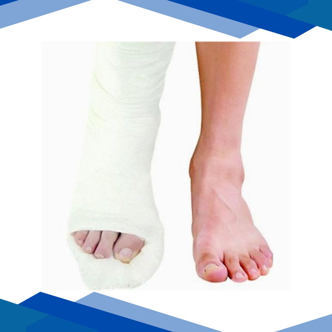 Dynamic Top Cast Plaster of Paris Bandage 2.7M 15 cm (4122-005)